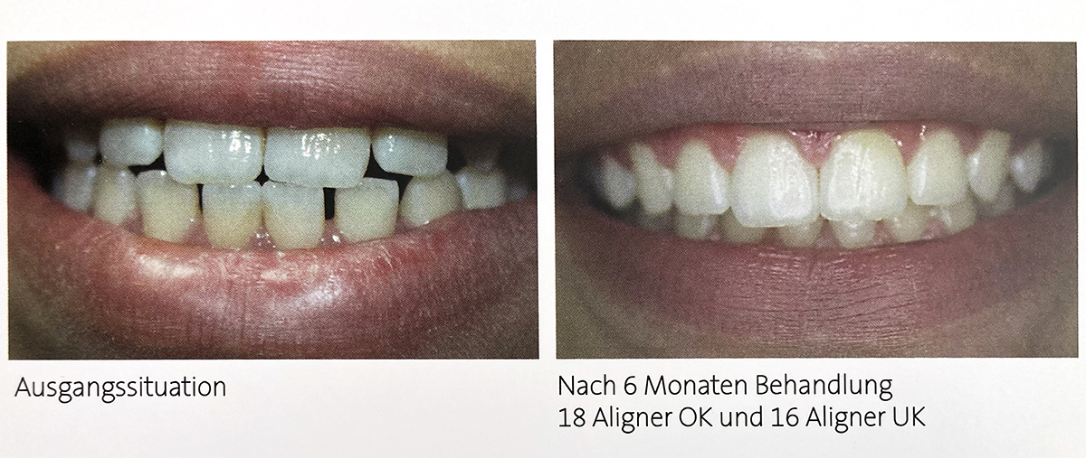 Invisalign